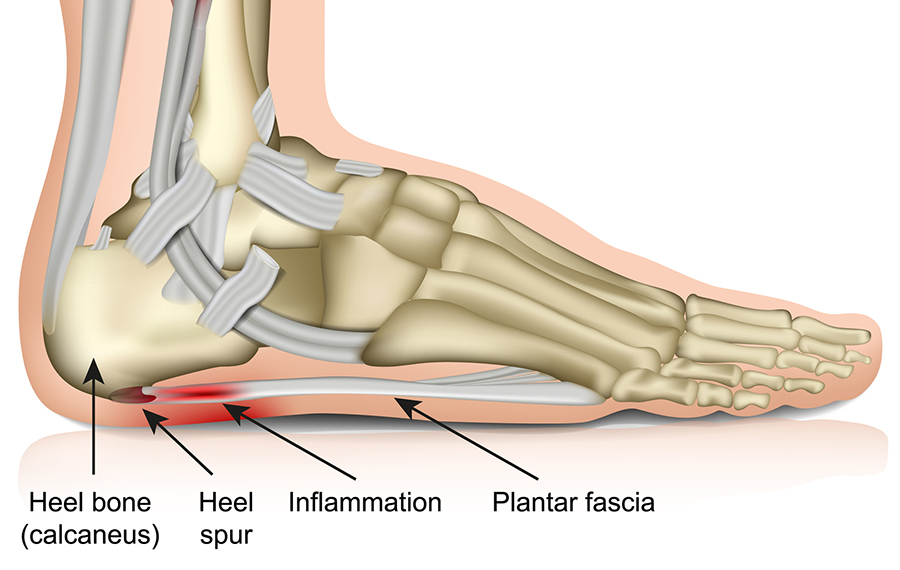 Heel and bone spurr physiotherapy services in Toronto 