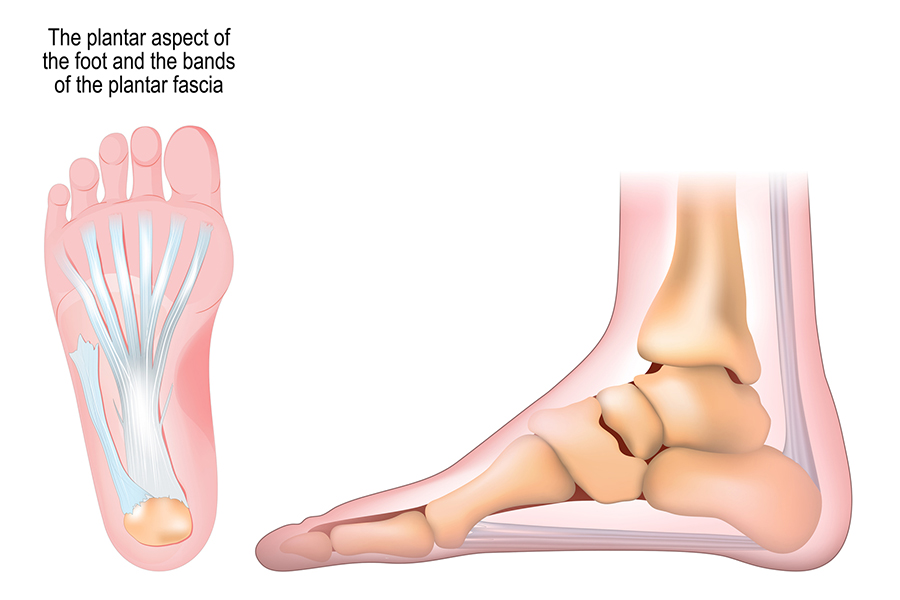 Plantar fasciitis physiotherapy in Toronto