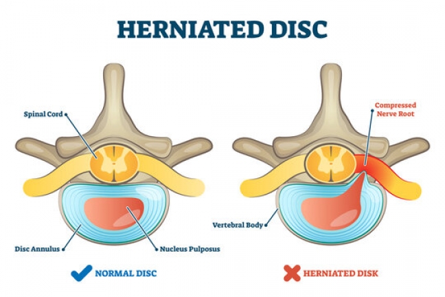 What You Should Know About a Herniated Disc on Your Sciatic Nerve - The  Nerve & Disc Institute