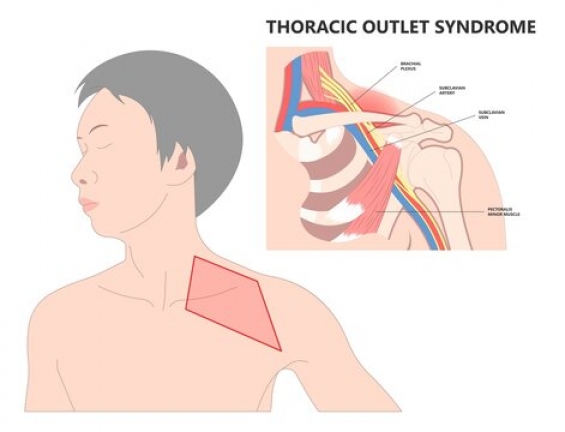 Thoracic Outlet Syndrome - Learn how you can help reduce TOS - Thoracic Outlet Syndrome Symptoms - Get Thoracic Outlet Syndrome Help Toronto TOS Clinic 001